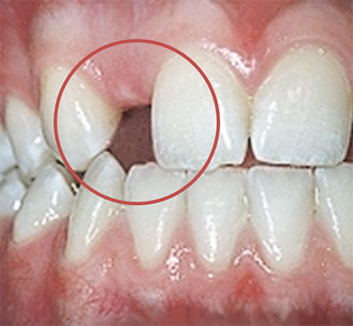 Ortodonzia nelle agenesie